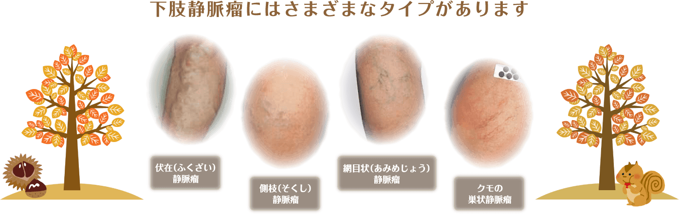 下肢動脈瘤にはさまざまなタイプがあります