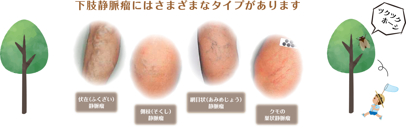 下肢動脈瘤にはさまざまなタイプがあります