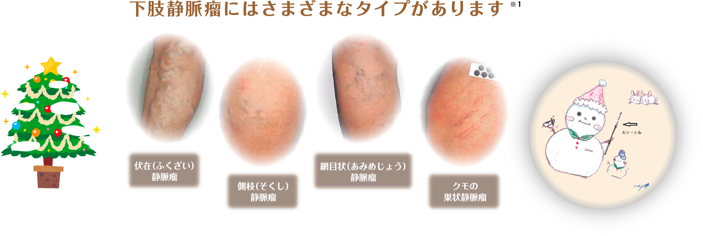 下肢動脈瘤にはさまざまなタイプがあります